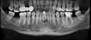 CBCT abnormal endodontic morphology